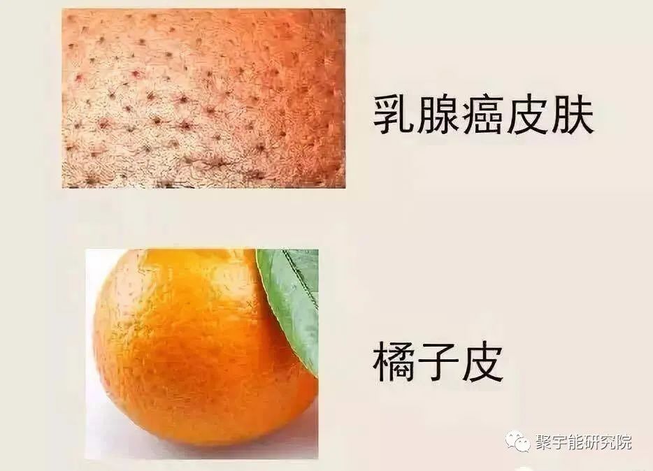 金日光教授:【《黄帝内经》漫谈•之六】林佳媚主任很想知道女性乳腺癌里生命动力阴阳源精分布(图3) 3.jpg