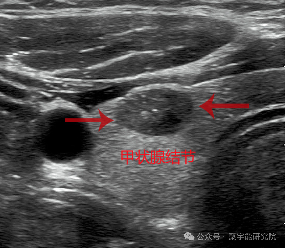 我和动力液的故事 | 小心颈部“炸弹”—甲状腺结节(图8) 微信图片_20250805150856.png