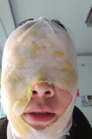 瞬间爆炸,女子脸部被严重烫伤!网友:这个“小妙招”我也差点信了(图1) 1a.jpg